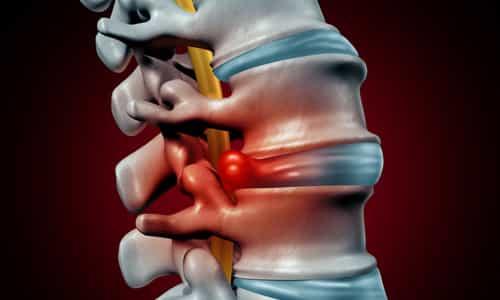 treatment of bulging disc in neck 