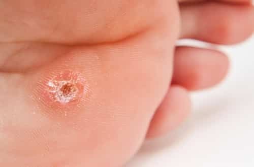 A plantar wart grows on the sole of the foot. It tends to grow inward and can be confused with a callus because it forms a thick layer of skin.