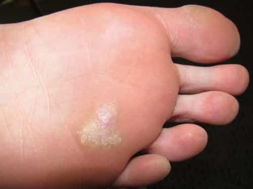 Plantar Warts