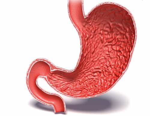 Duodenal Ulcer Causes Symptoms Treatment 