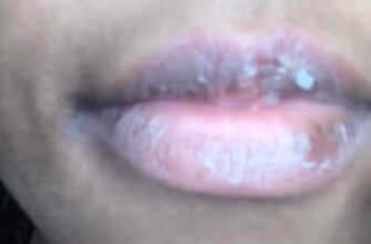 Why is My Lips So Dry