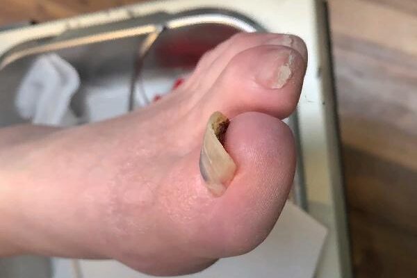 toenail fell off new one underneath