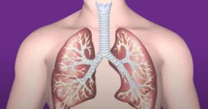 Chronic Cough: Causes and Treatments - IYTmed.com