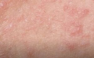 Difference Between Eczema and Hives - IYTmed.com