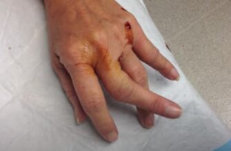 dislocated finger