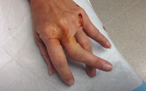 dislocated finger