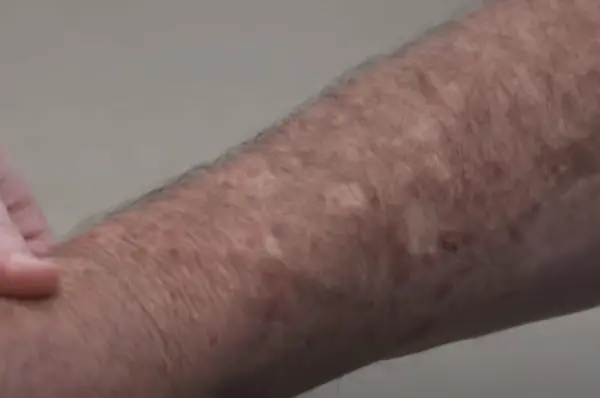 Skin Discoloration in Diabetes
