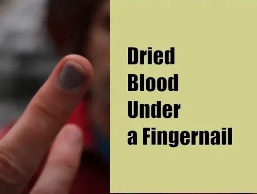 Dried Blood Under a Fingernail