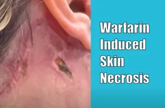 Warfarin-Induced Skin Necrosis