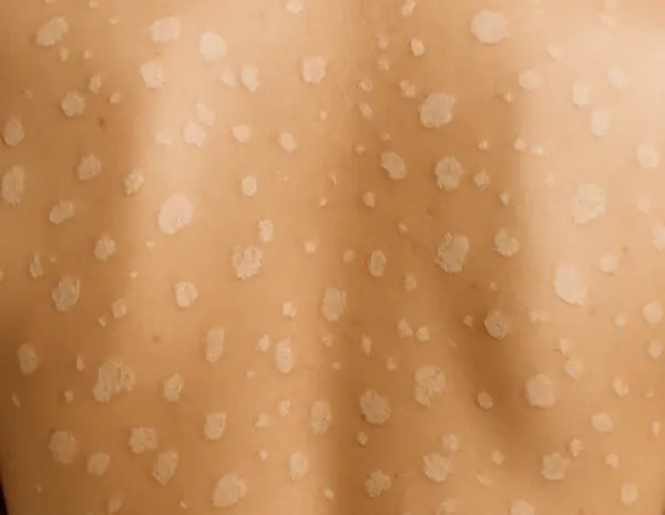 White and light brown skin spots on back – tinea versicolor example